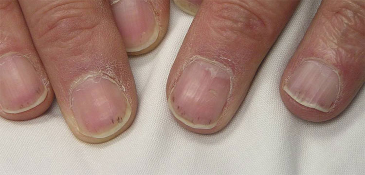 bumps on fingernails